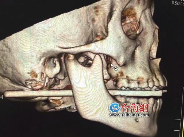含筷子玩耍男孩口腔被插穿所幸没伤及大血管